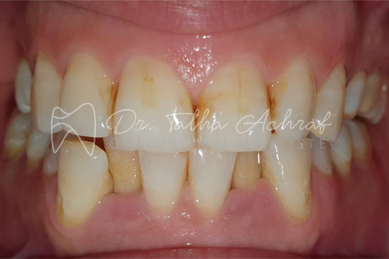 invisalign settat avant