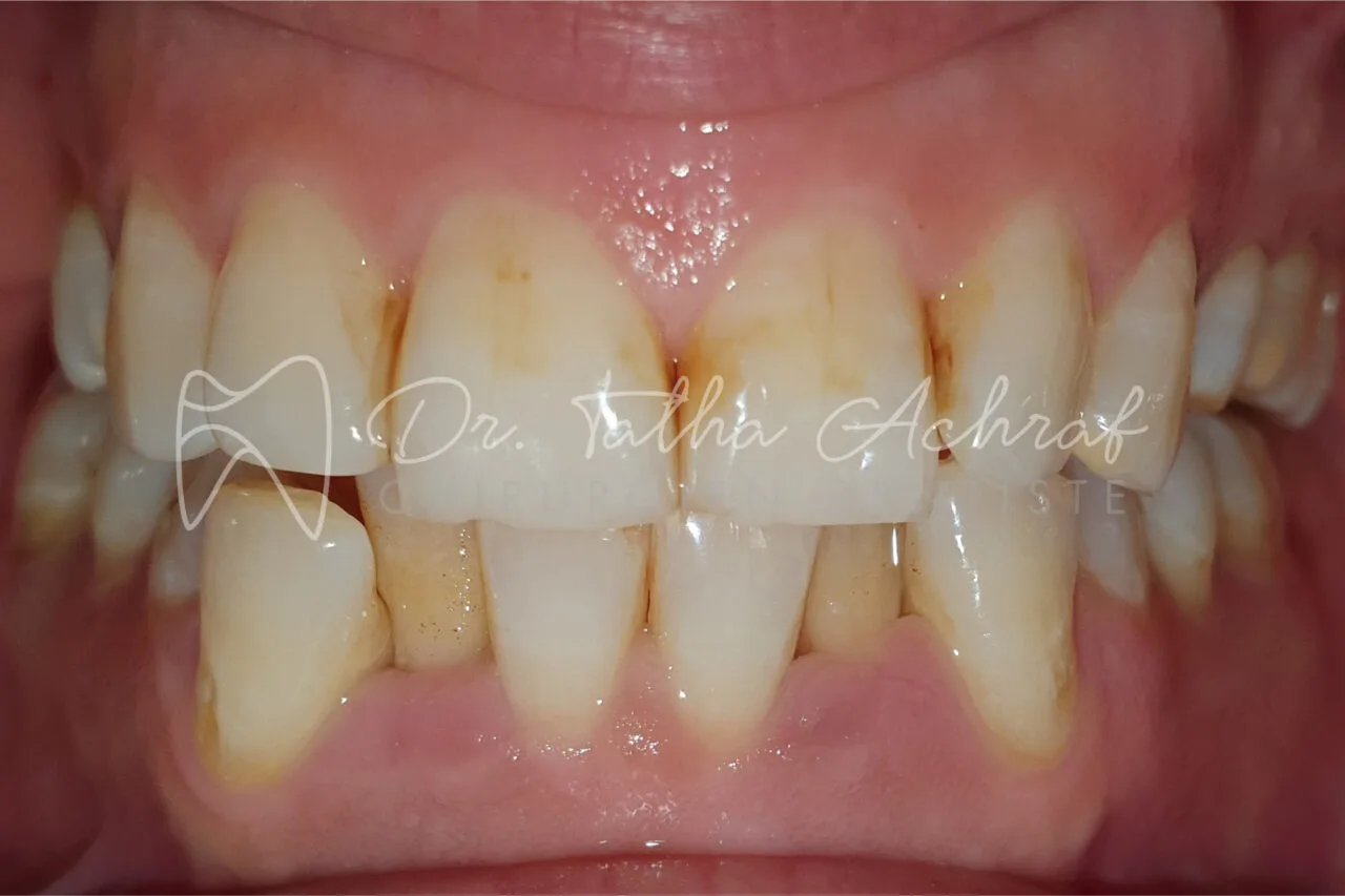 invisalign settat avant