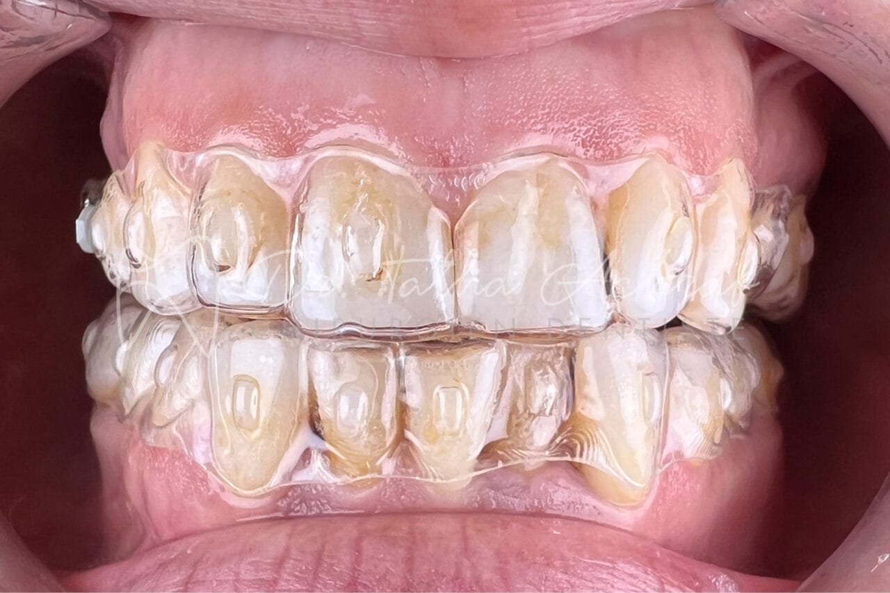 invisalign settat en cours