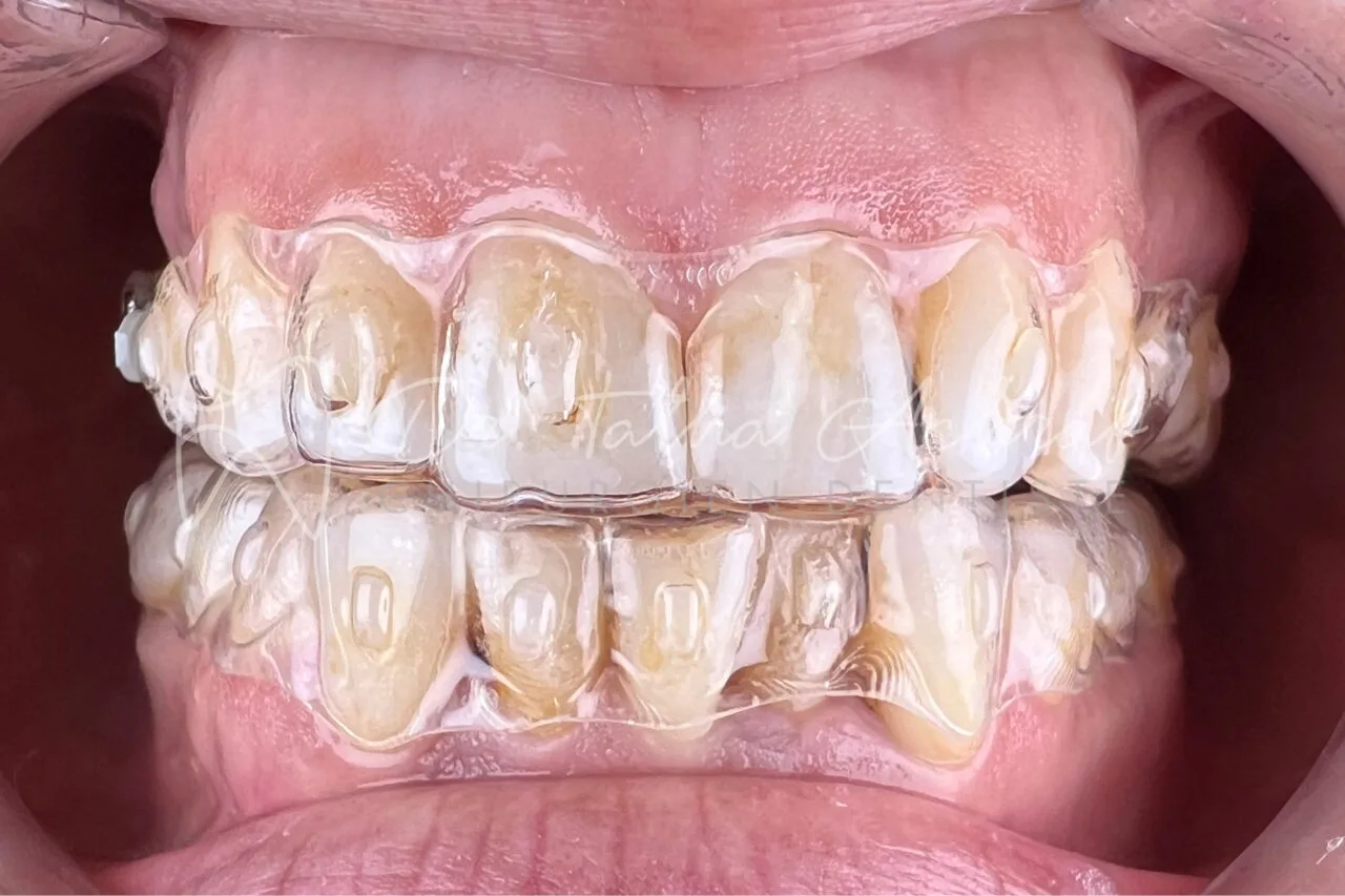 invisalign settat en cours