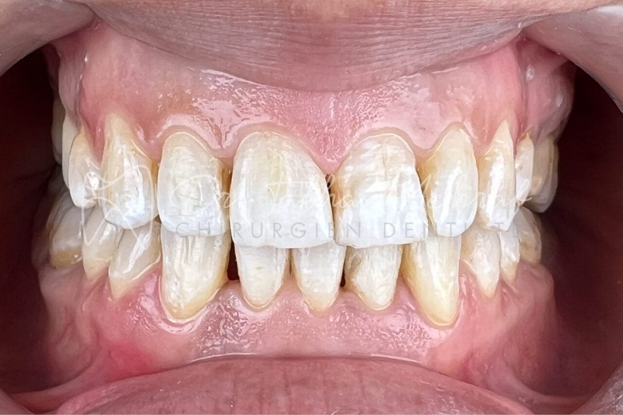 invisalign settat après