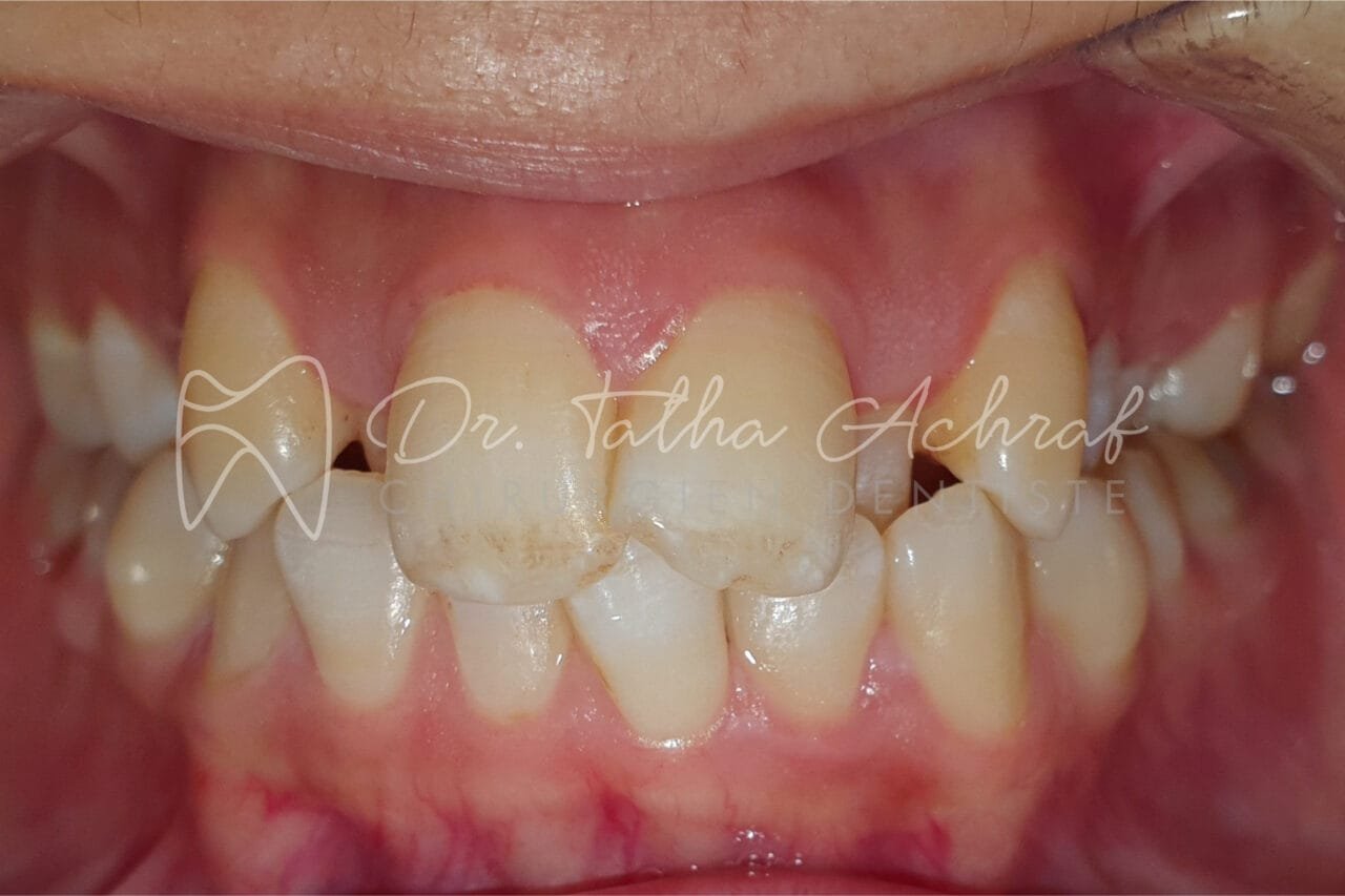 orthodontie settat avant