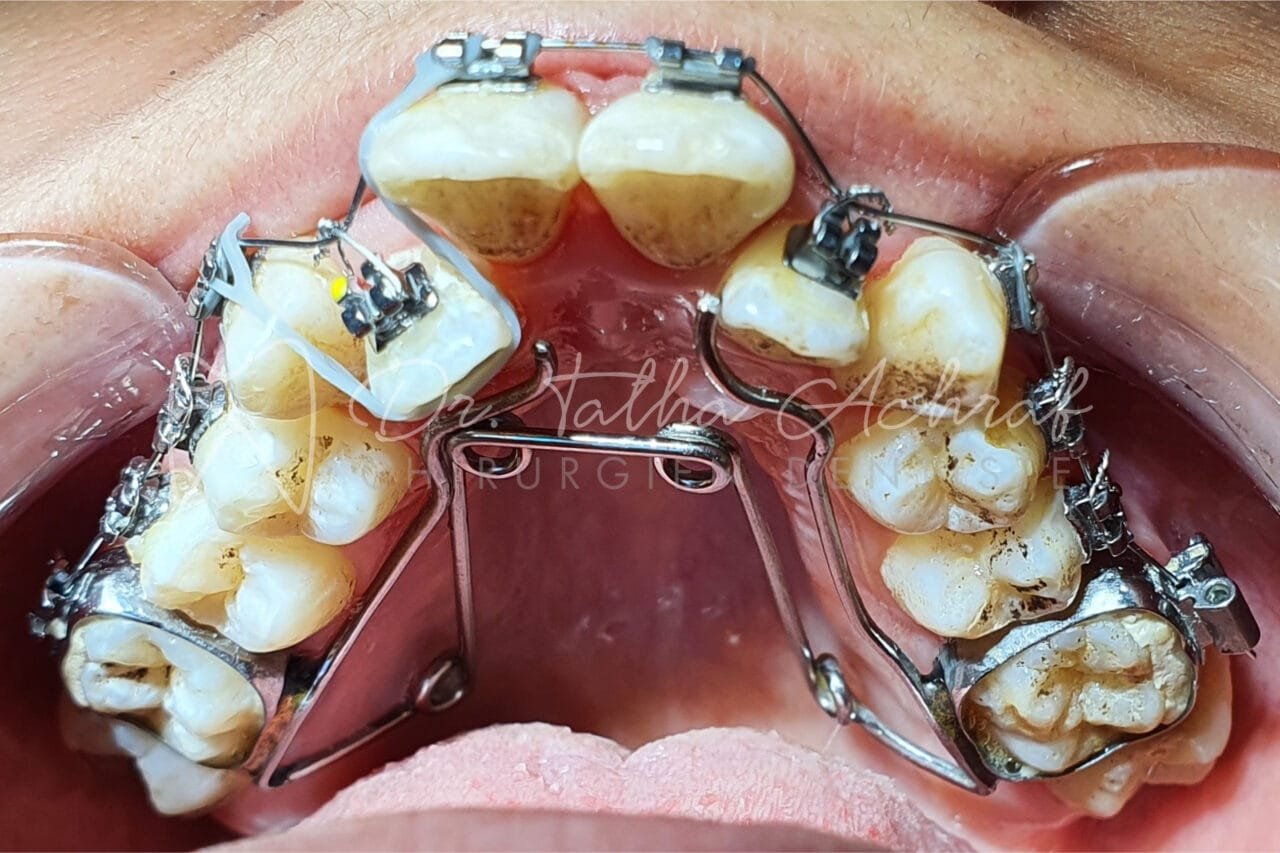 orthodontie settat en cours