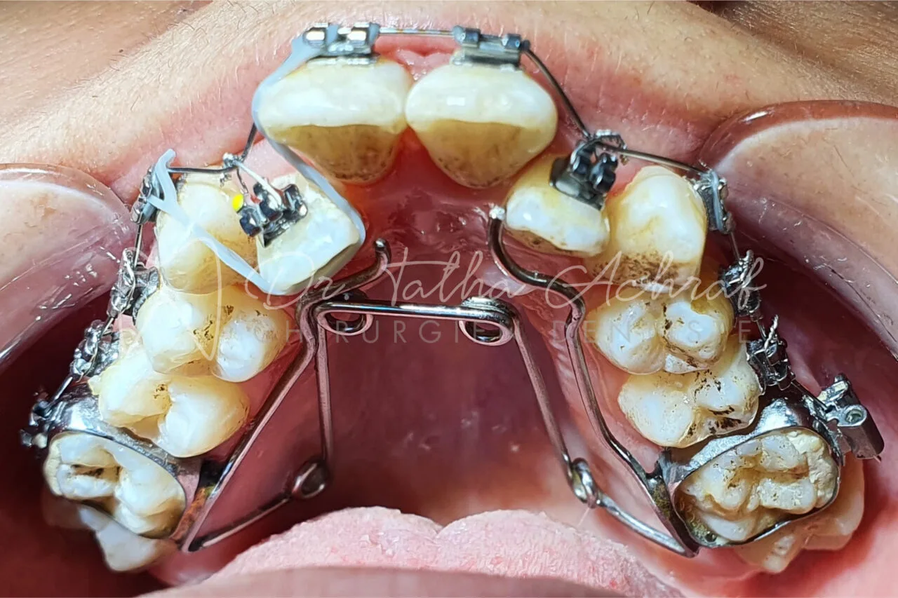 orthodontie settat en cours