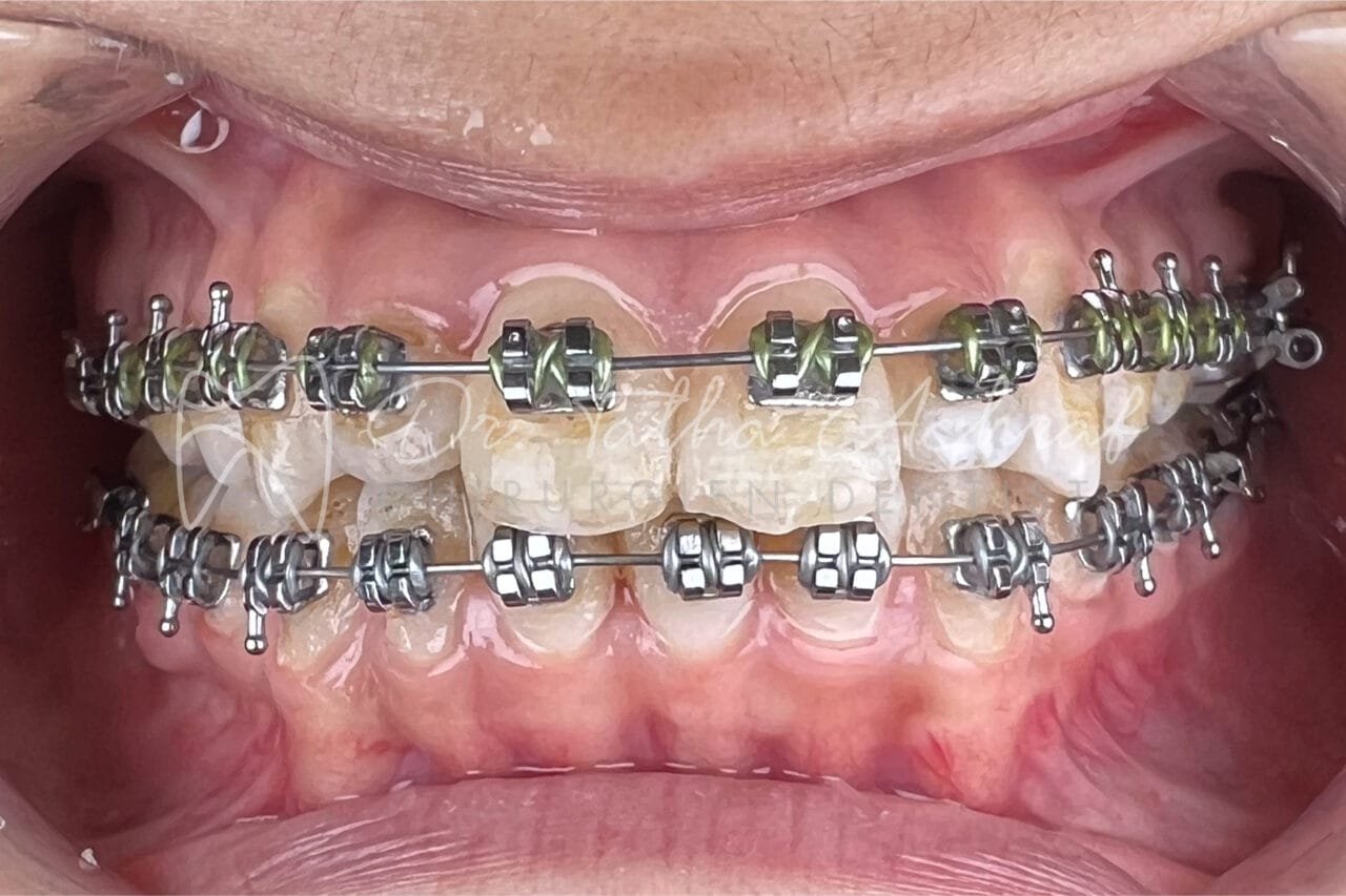 orthodontie settat après
